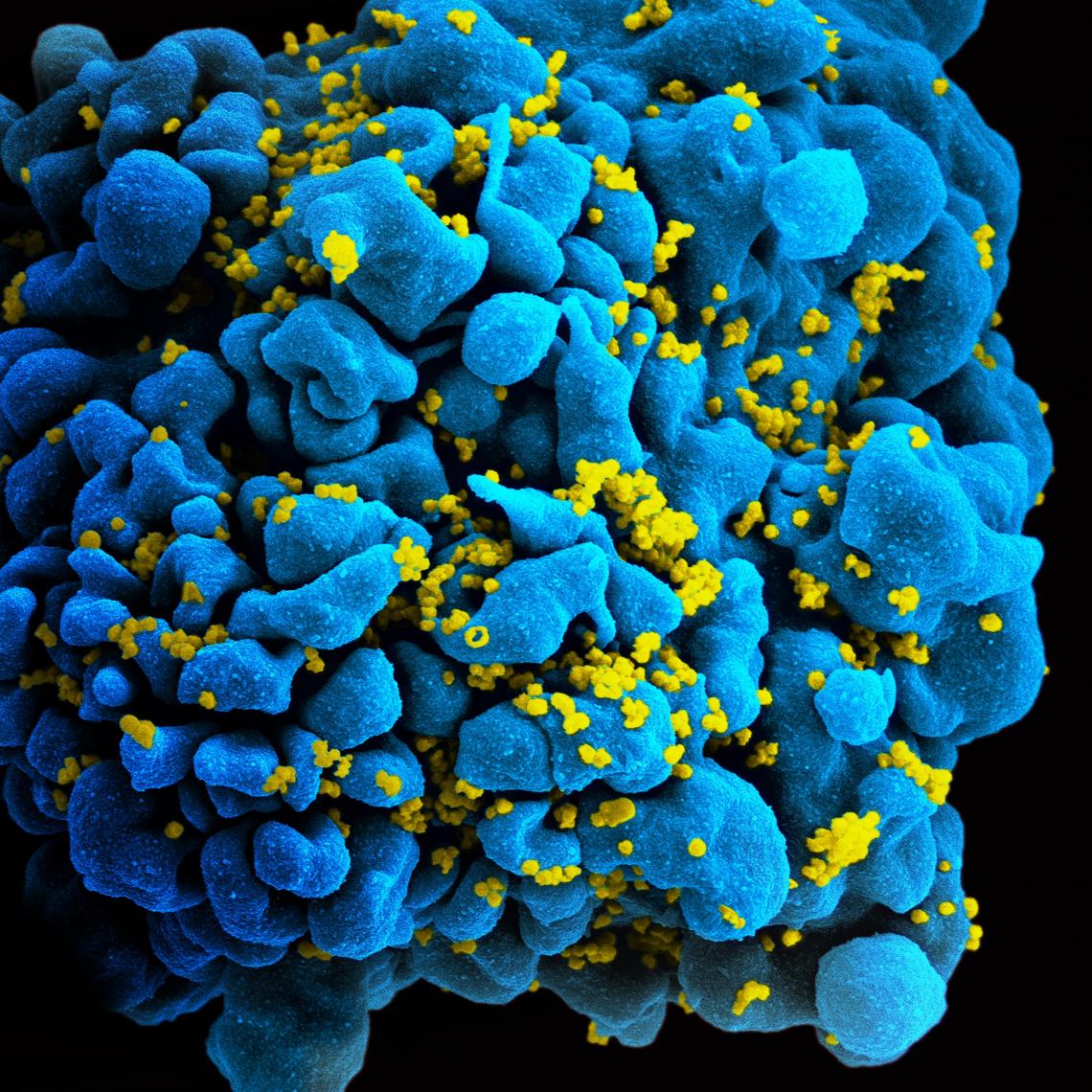 HIV particles  infecting a T-cell, viewed under a scanning electron microscope. T-cells perform important functions in our immune system. 